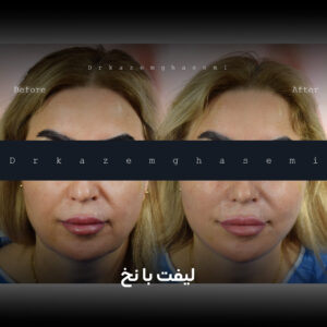 نخ لیفت مایع اینشیپ تخفیف دار