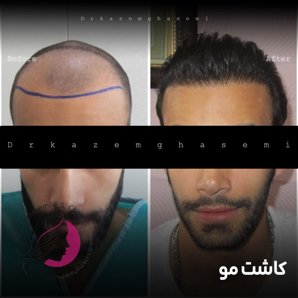 پس از کاشت