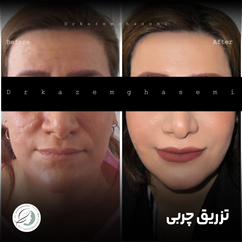 تزریق چربی صورت قبل و بعد - دکتر کاظم قاسمی
