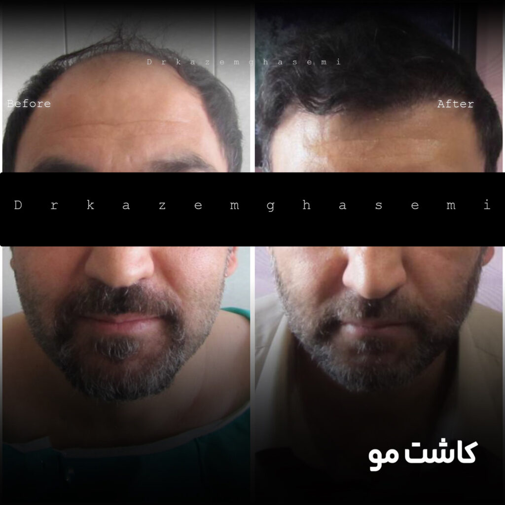 کاشت مو3