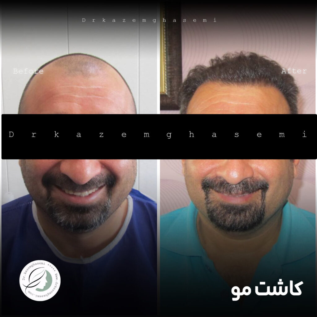 کاشت1