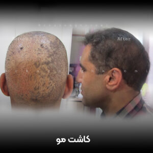 کاشت مو