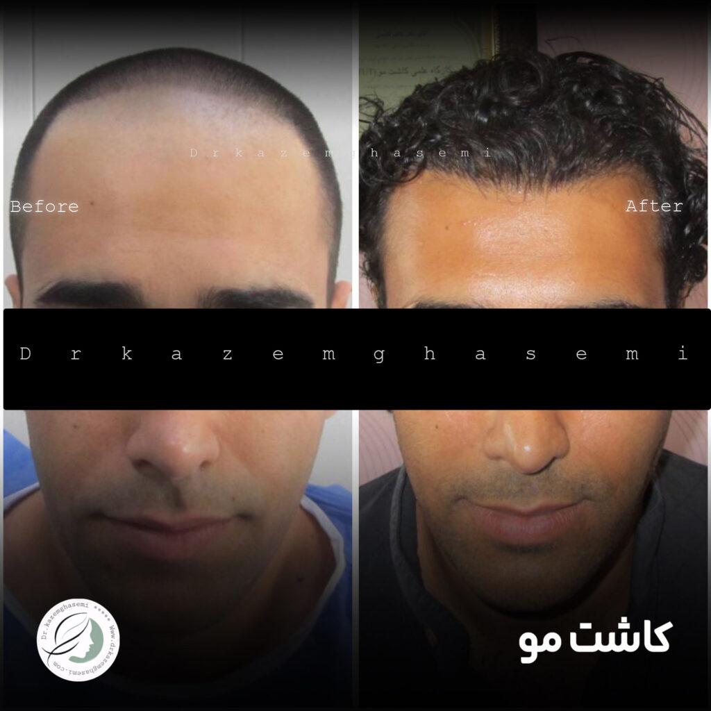 کاشت2