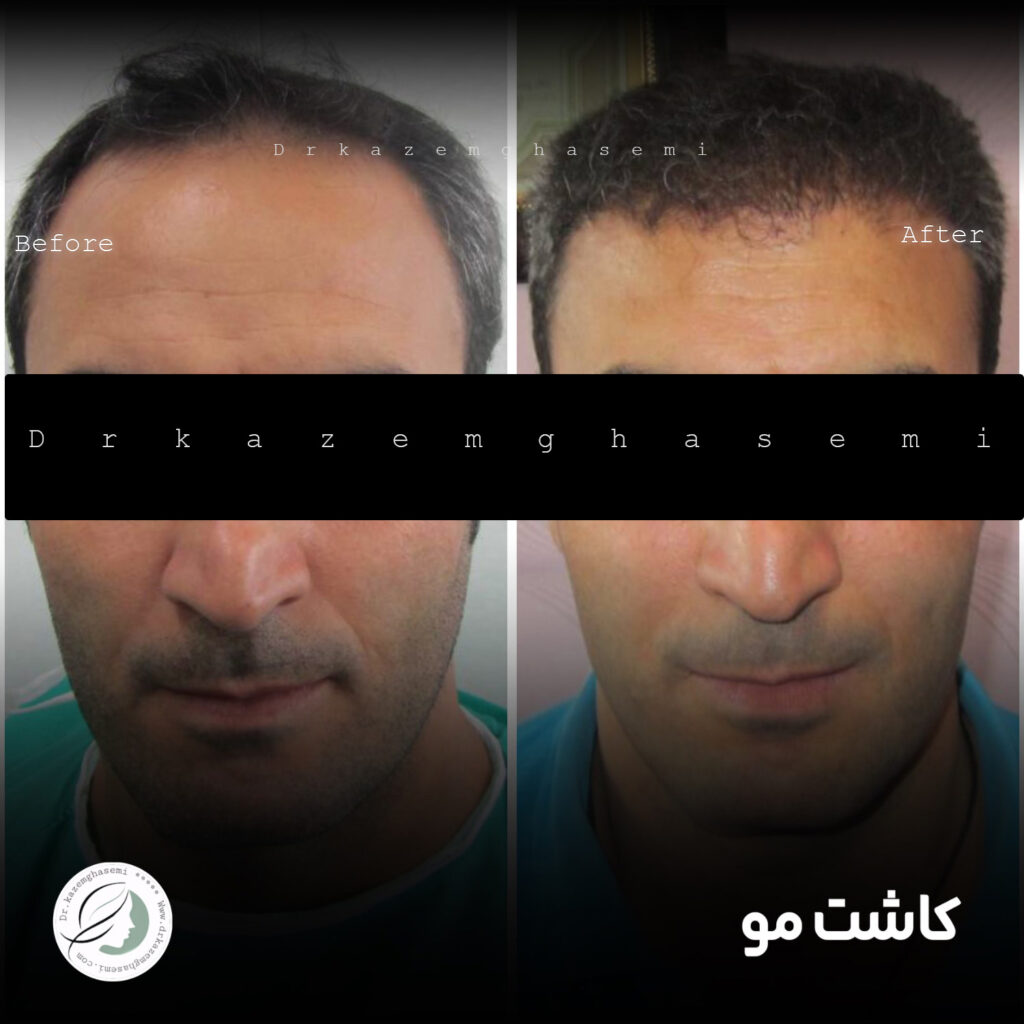 کاشت3