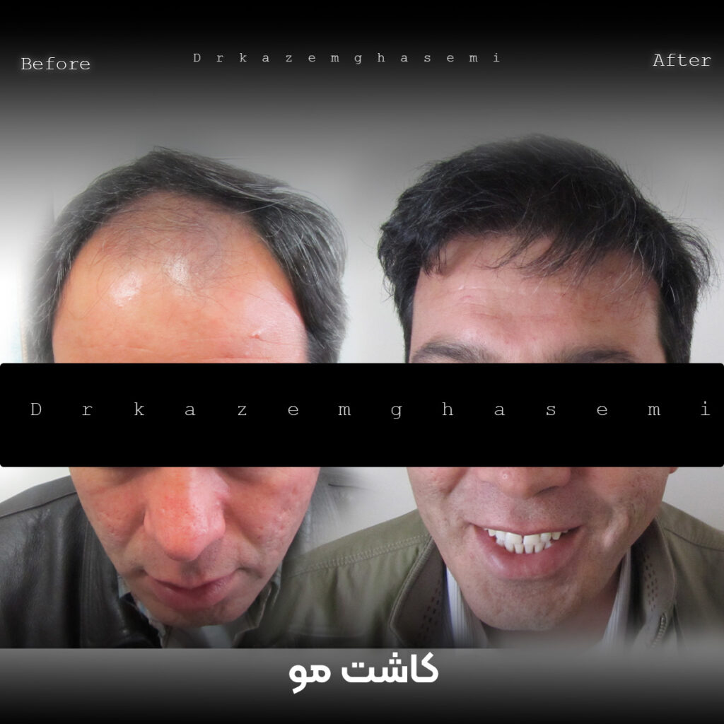 کاشت6