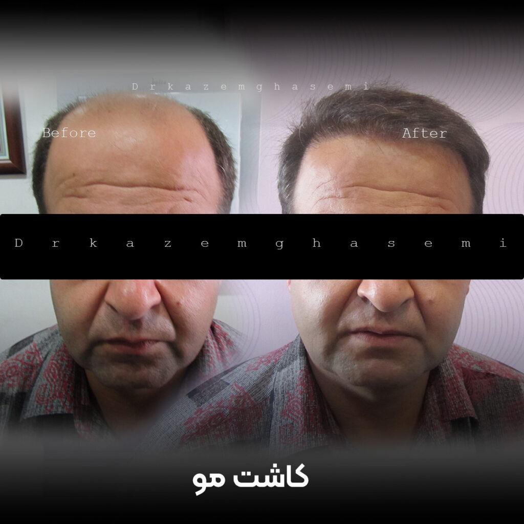 نتیجه کاشت مو در کرج