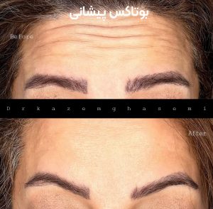 بوتاکس صورت