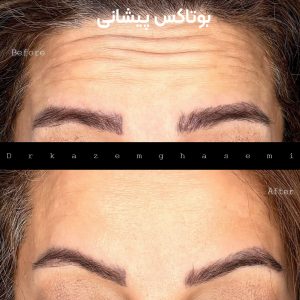 بوتاکس صورت