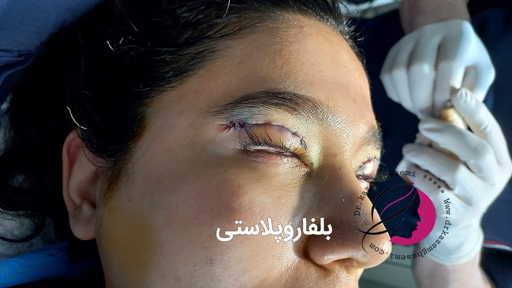 جراحی پلک (بلفاروپلاستی) | انواع، هزینه و مراقبت