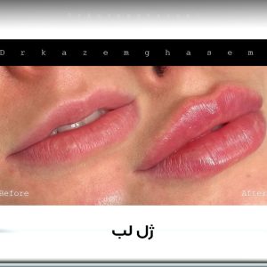 فیلر لب قبل و بعد