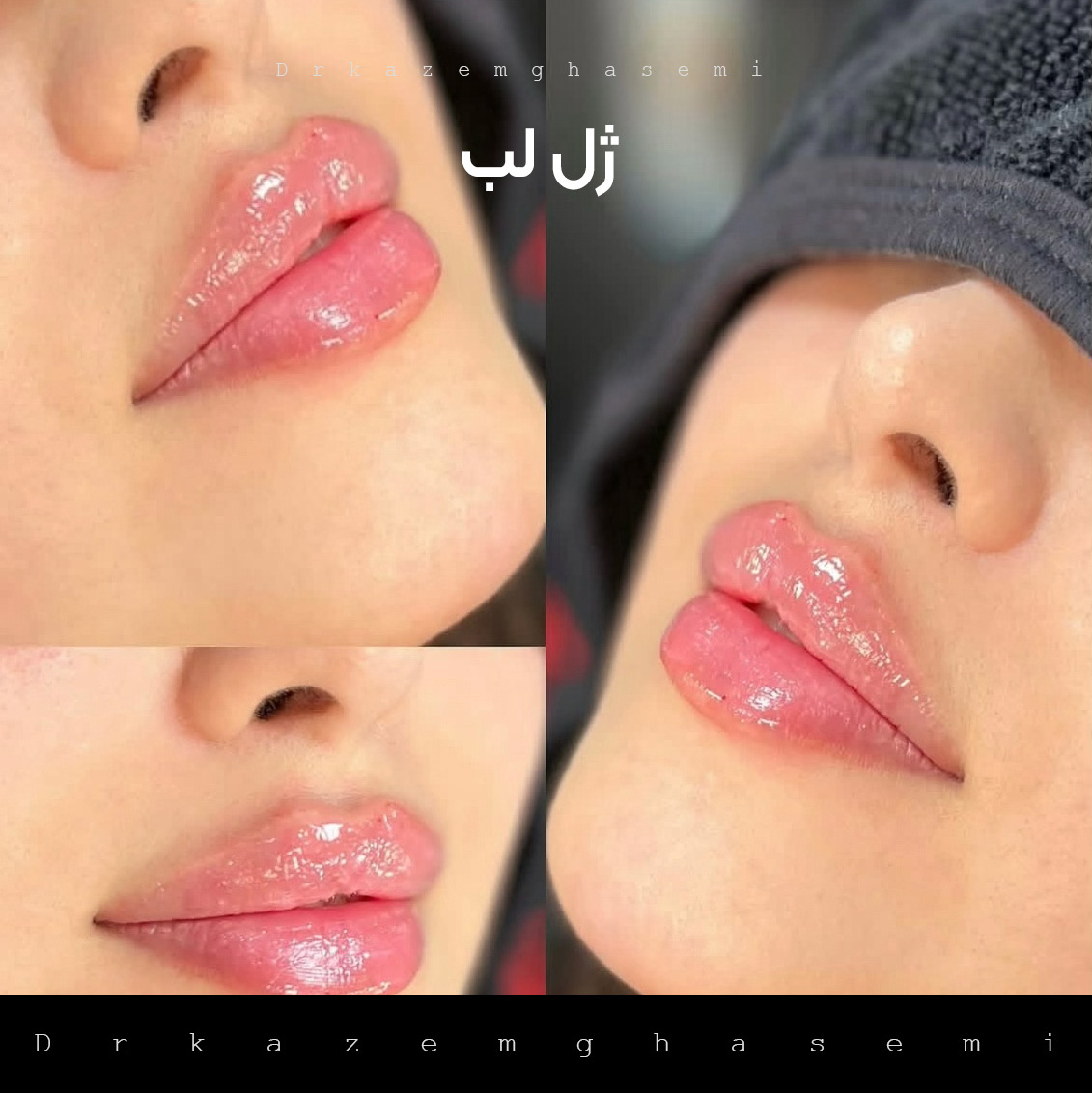تزریق ژل لب در کرج