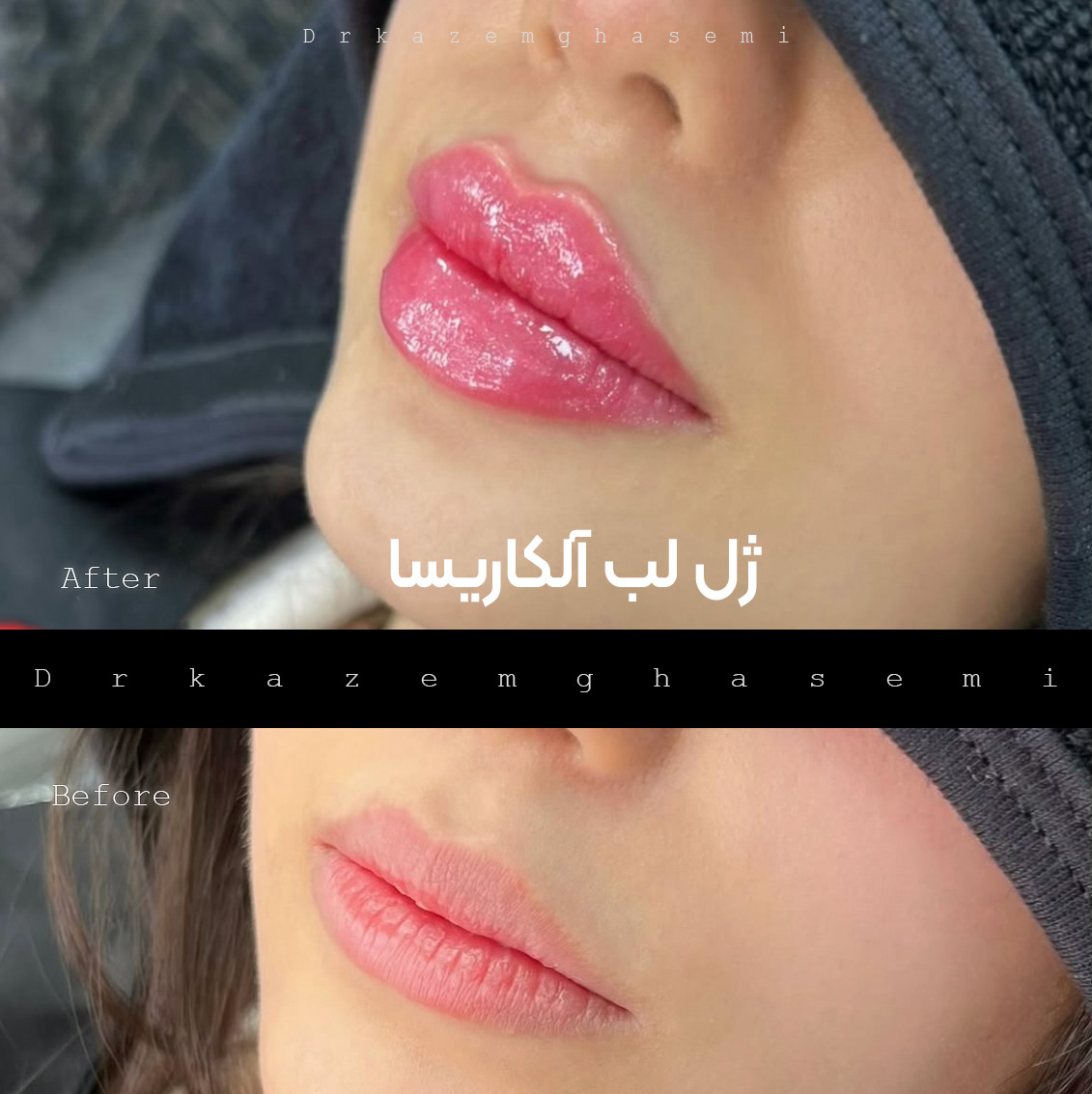 قبل و بعد ژل لب