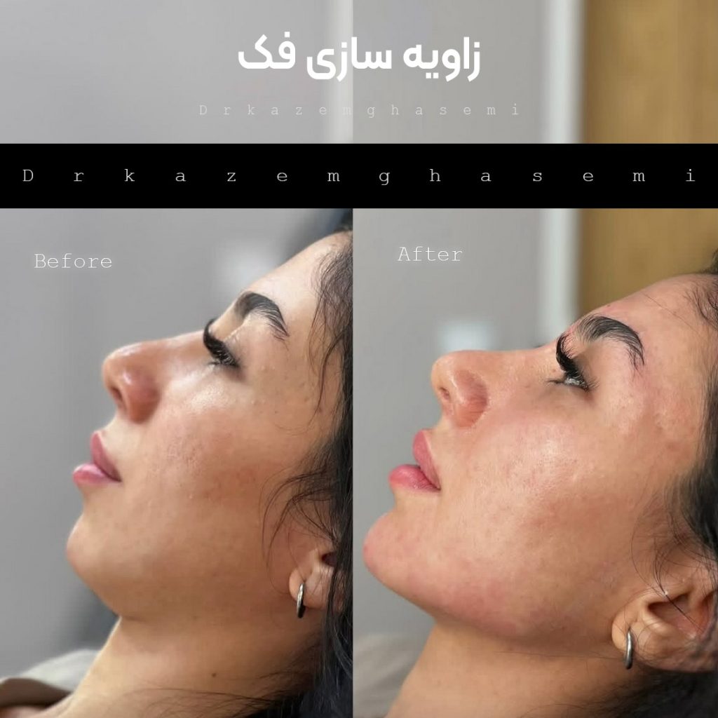 نتیجه تزریق ژل و مزوژل در کلینیک دکتر کاظم قاسمی کرج