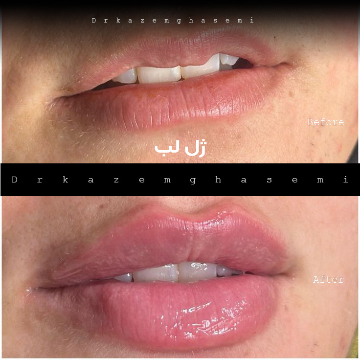 قبل و بعد ژل لب