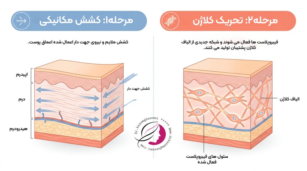 مکانیسم عملکرد لیفت نخ