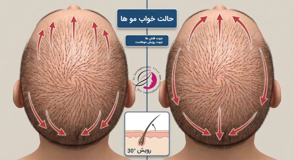 تفاوت شکاف ساژیتال و کورونال در کاشت مو