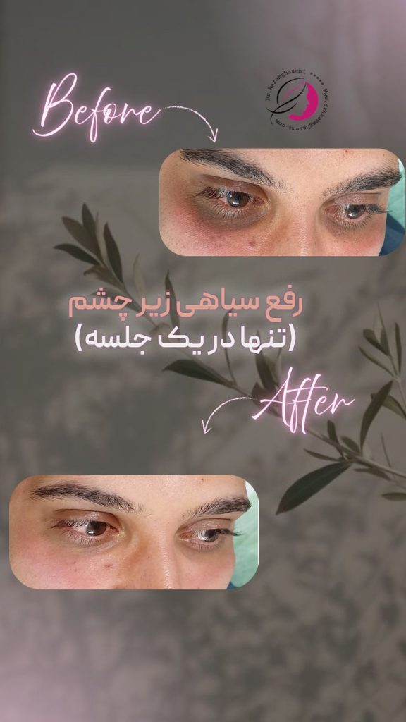 پی ار پی زیر چشم