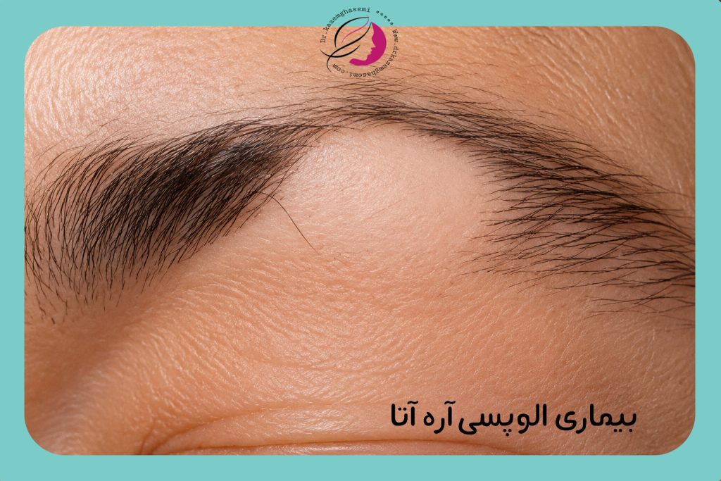 بیماری آلوپسی آره آتا