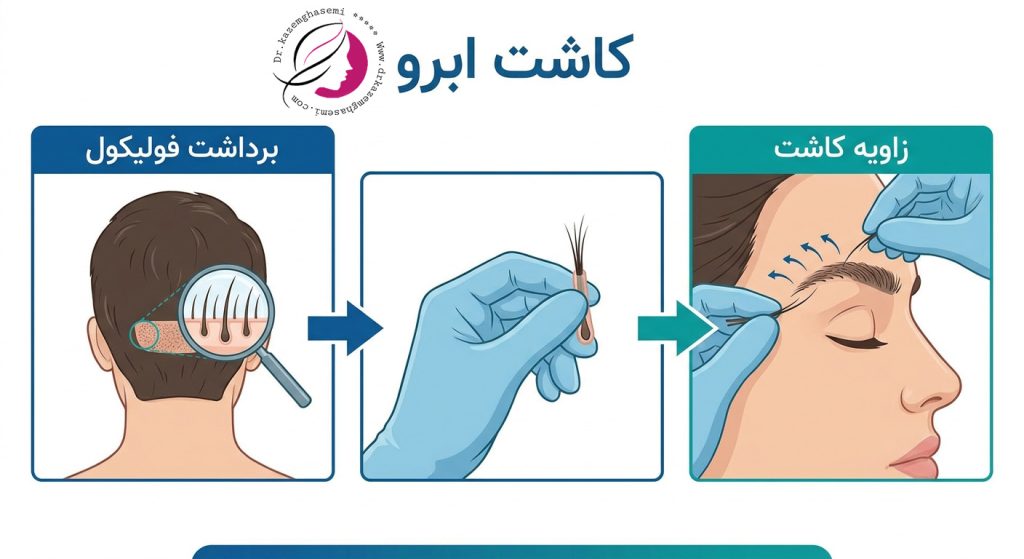 نحوه کاشت ابرو در کلینیک دکتر کاظم قاسمی