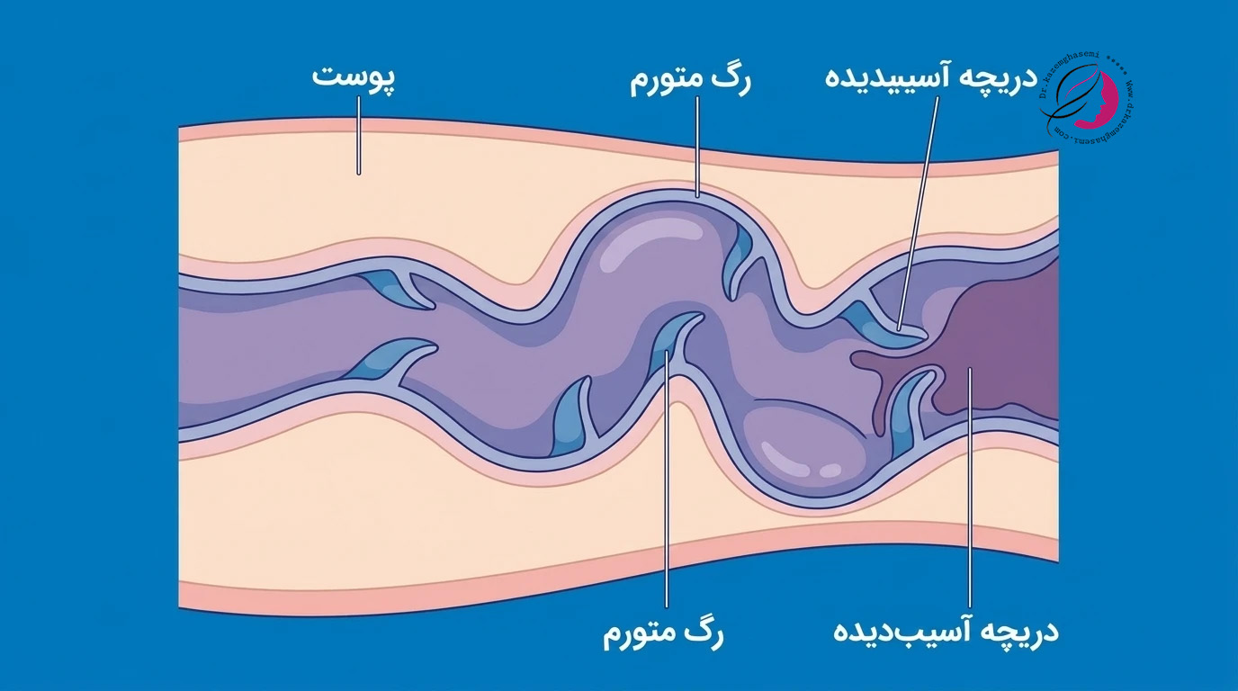 هزینه لیزر واریس