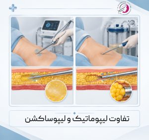 تفاوت لیپوساکشن و لیپوماتیک کلینیک دکتر کاظم قاسمی