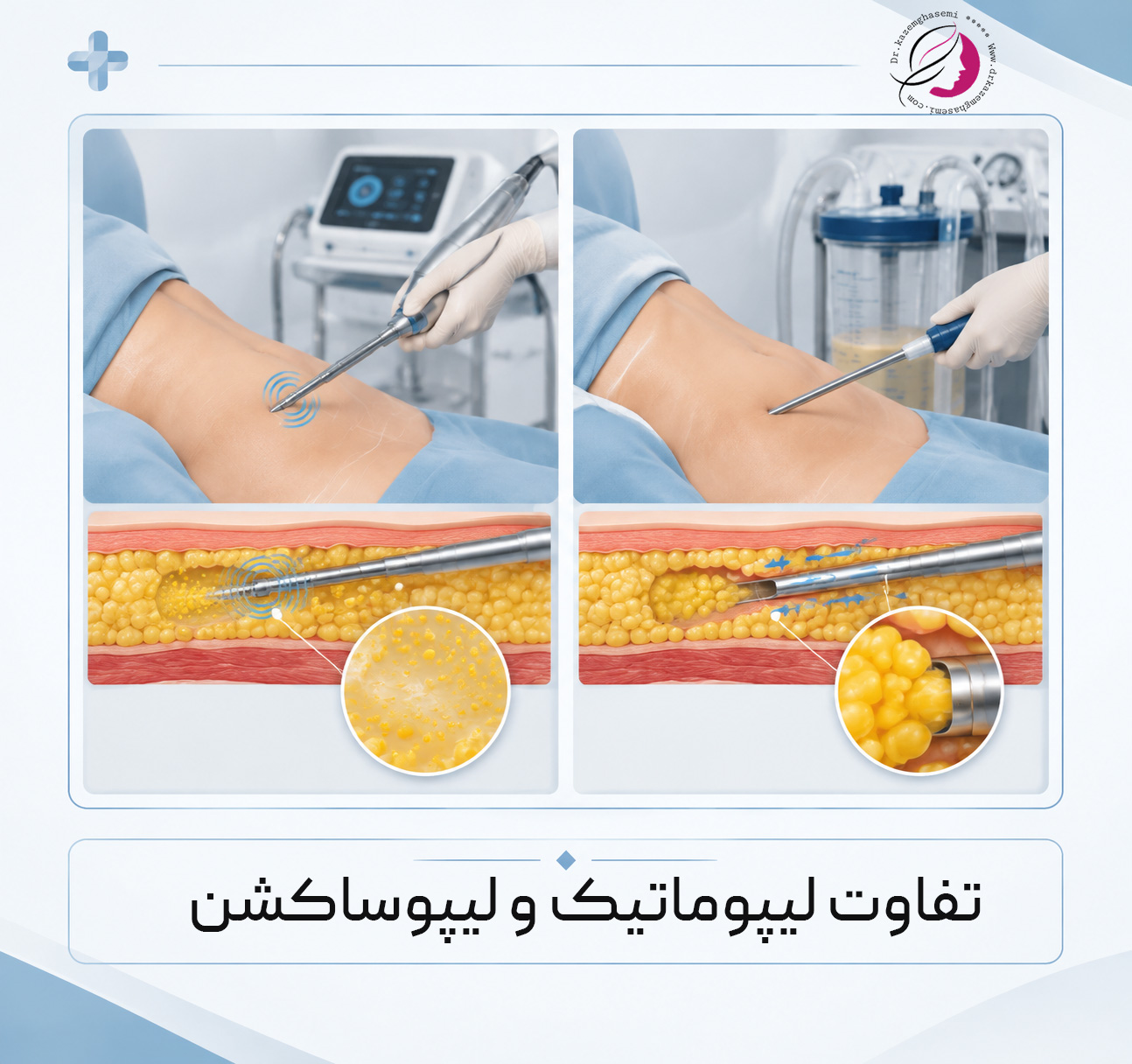 تفاوت لیپوساکشن و لیپوماتیک کلینیک دکتر کاظم قاسمی