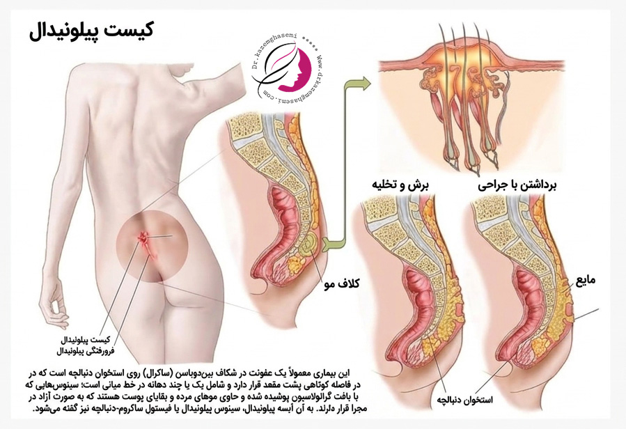 جراحی کیست پیلونیدال کرج
