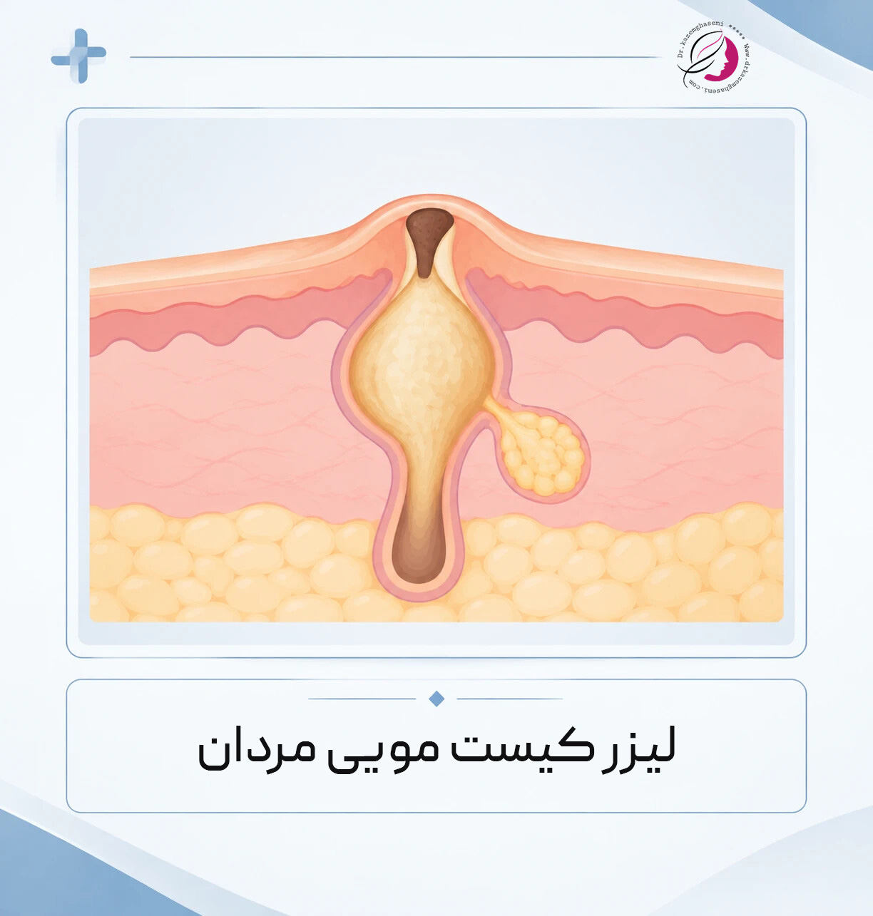 لیزر کیست مویی در کرج